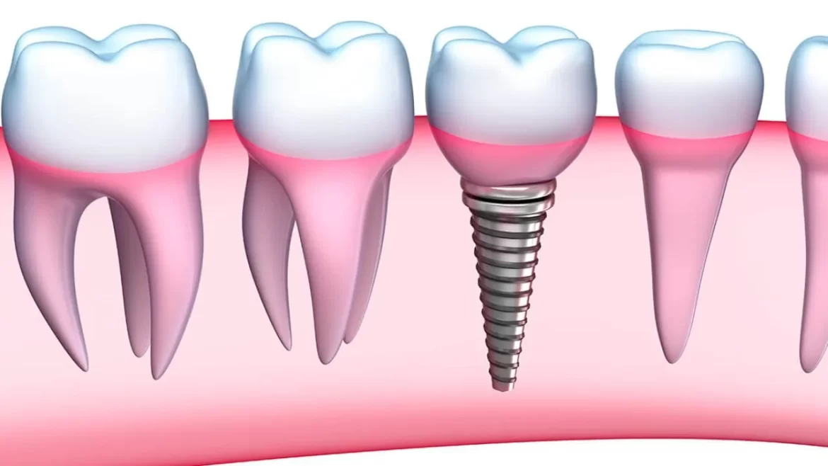5 Simple Reasons Why Dental Implants Are Important?