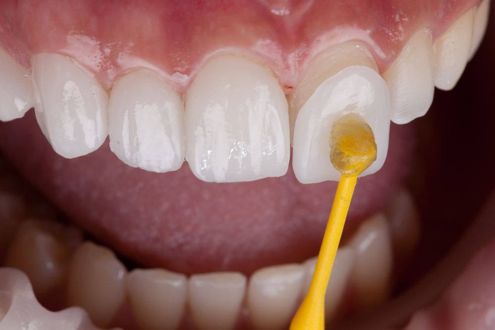 When Are Porcelain Veneers Appropriate? Cases and Considerations