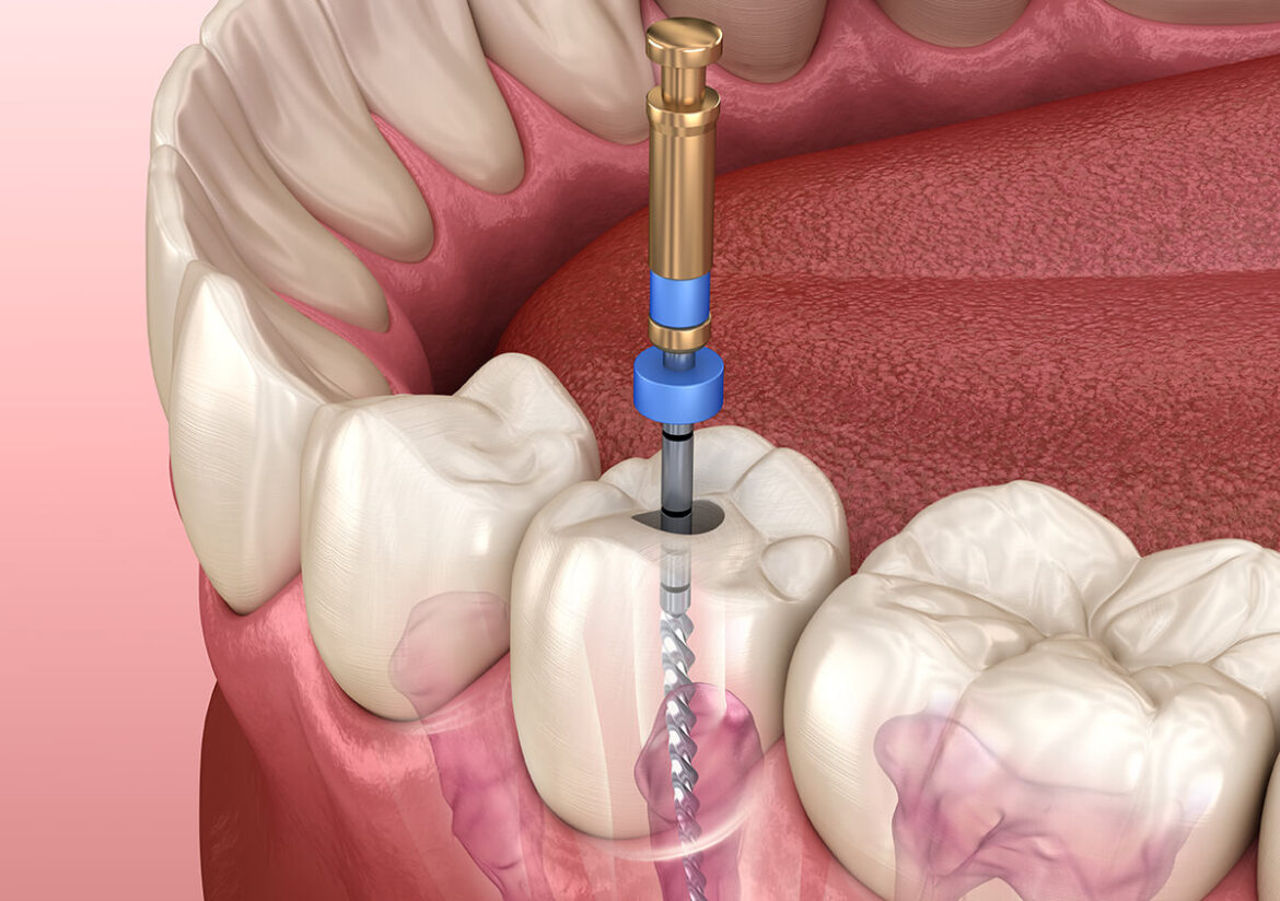 Endodontic Elegance: The Art and Science of Root Canal Healing