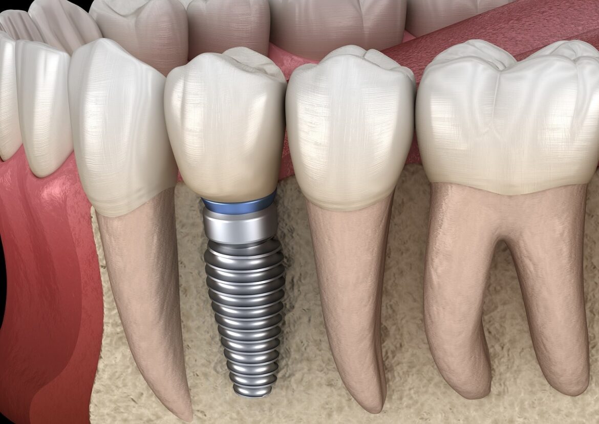Recognizing the Signs of Broken Dental Roots in Burlingame, CA