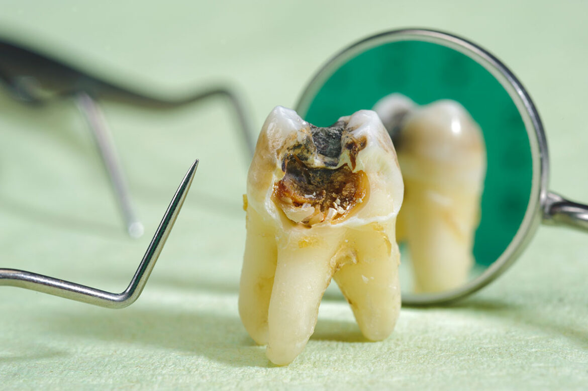 Sealants: Your Secret Weapon Against Tooth Decay