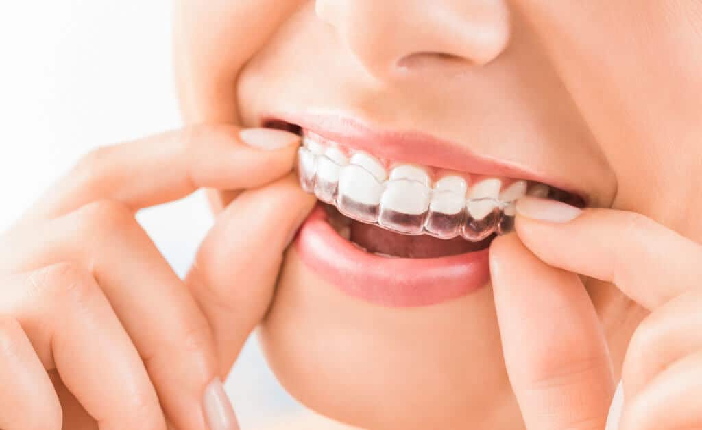 After Invisalign, Do You Have To Wear Retainers Forever?